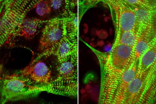 Human heart cells grown from stem cells show less robust muscle fibers (green) in high glucose conditions (left) compared to reduced glucose conditions (right).
