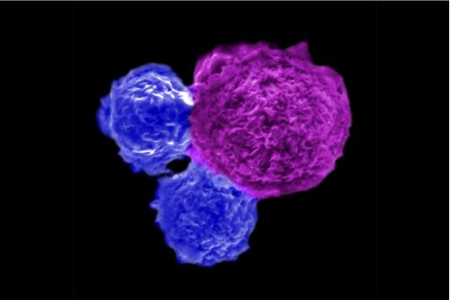 Human stem cell-engineered iNKT cells (blue) attack a human blood cancer cell (magenta).