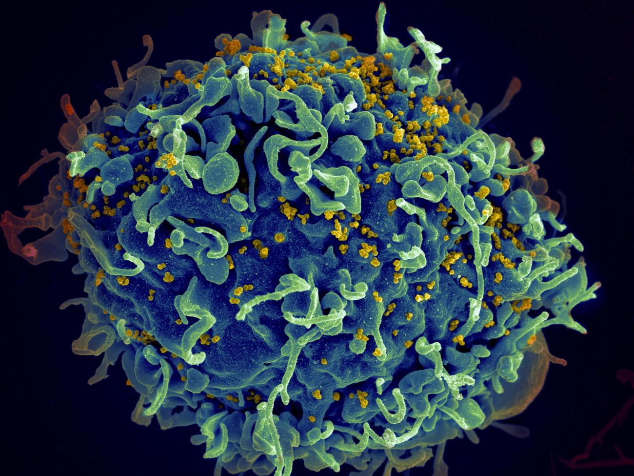 A human T cell, in blue, under attack by HIV, in yellow.